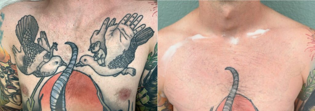 black sage studio, black sage laser, tattoo removal, full tattoo removal, milo Alfring